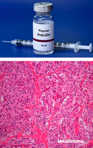 Diabetes e insulinoma - Quilo de ciencia podcast - Cienciaes.com