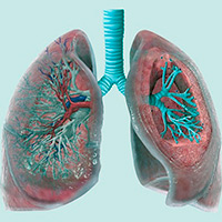 Neuronas e infecciones pulmonares - Quilo de Ciencia podcast - CienciaEs.com