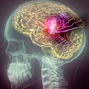Marcapasos para el cerebro - Cierta Ciencia podcast  - CienciaEs.com