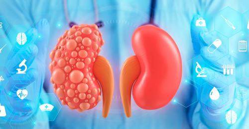 Poliquistosis renal - Hablando con Científicos podcast - Cienciaes.com